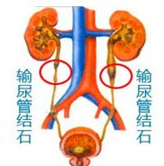 症状 尿道变细分叉,夜尿多 尿无力,尿道口脓肿血尿,尿道疼痛及阴茎痛